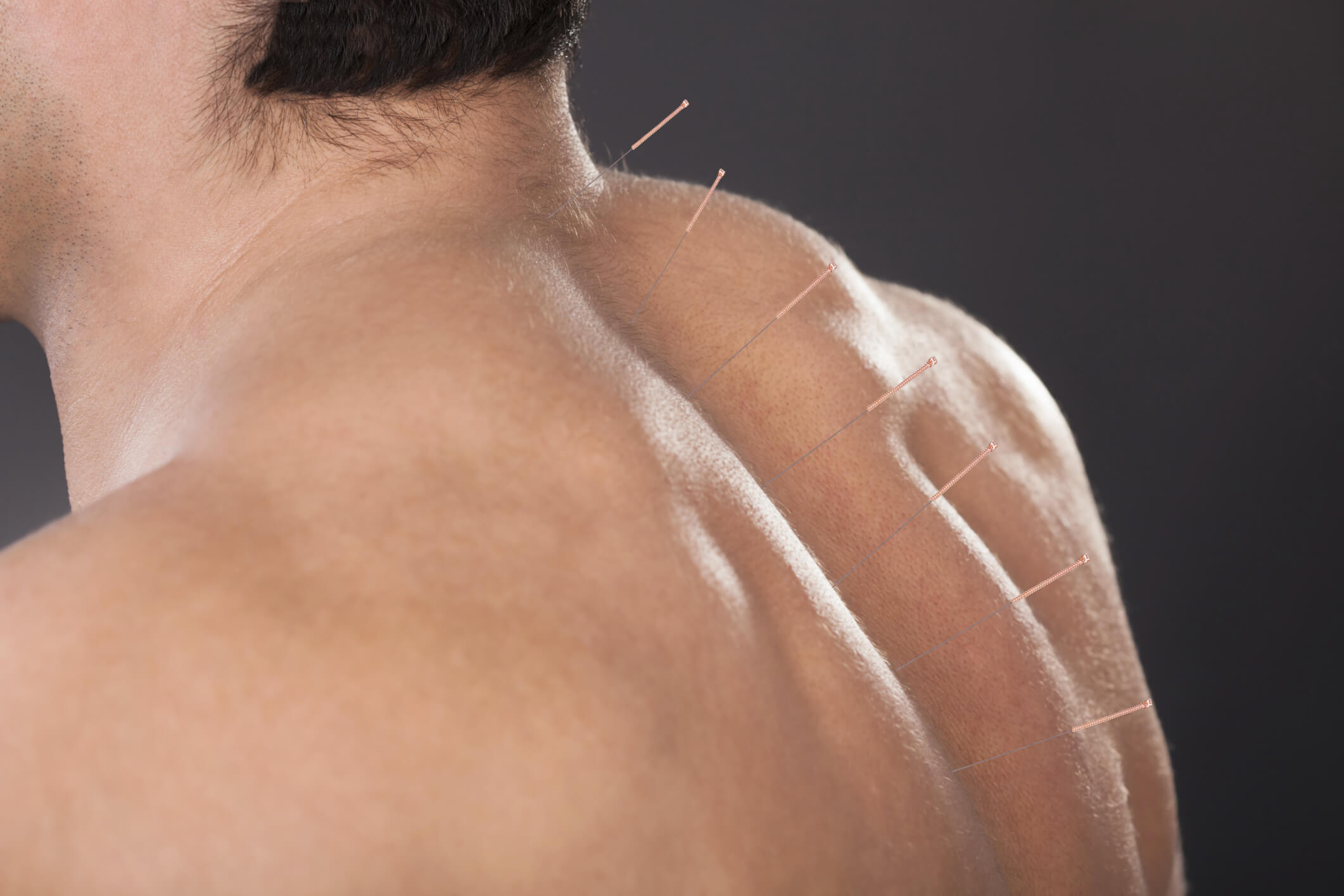 Acupuncture Services in Ridgewood, NY 11421 by Long Life Acupuncture